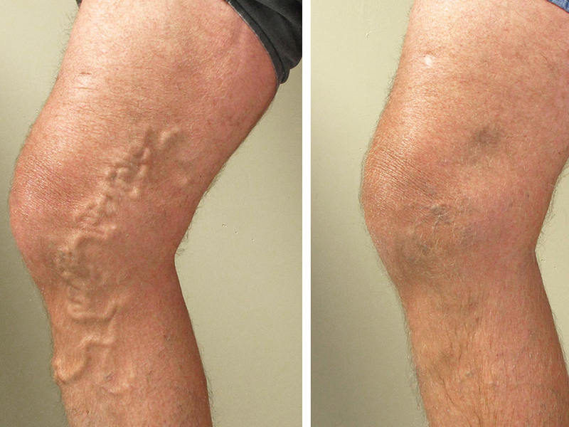 Varicose Veins –An Ayurvedic Perspective