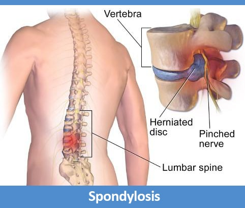 Treating Lumbar Spondylosis