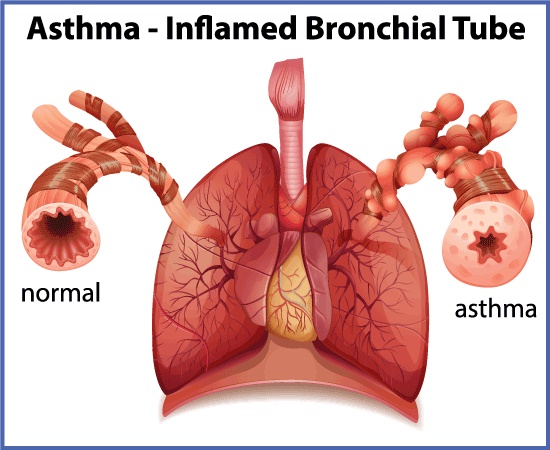 Treating Bronchial Asthma