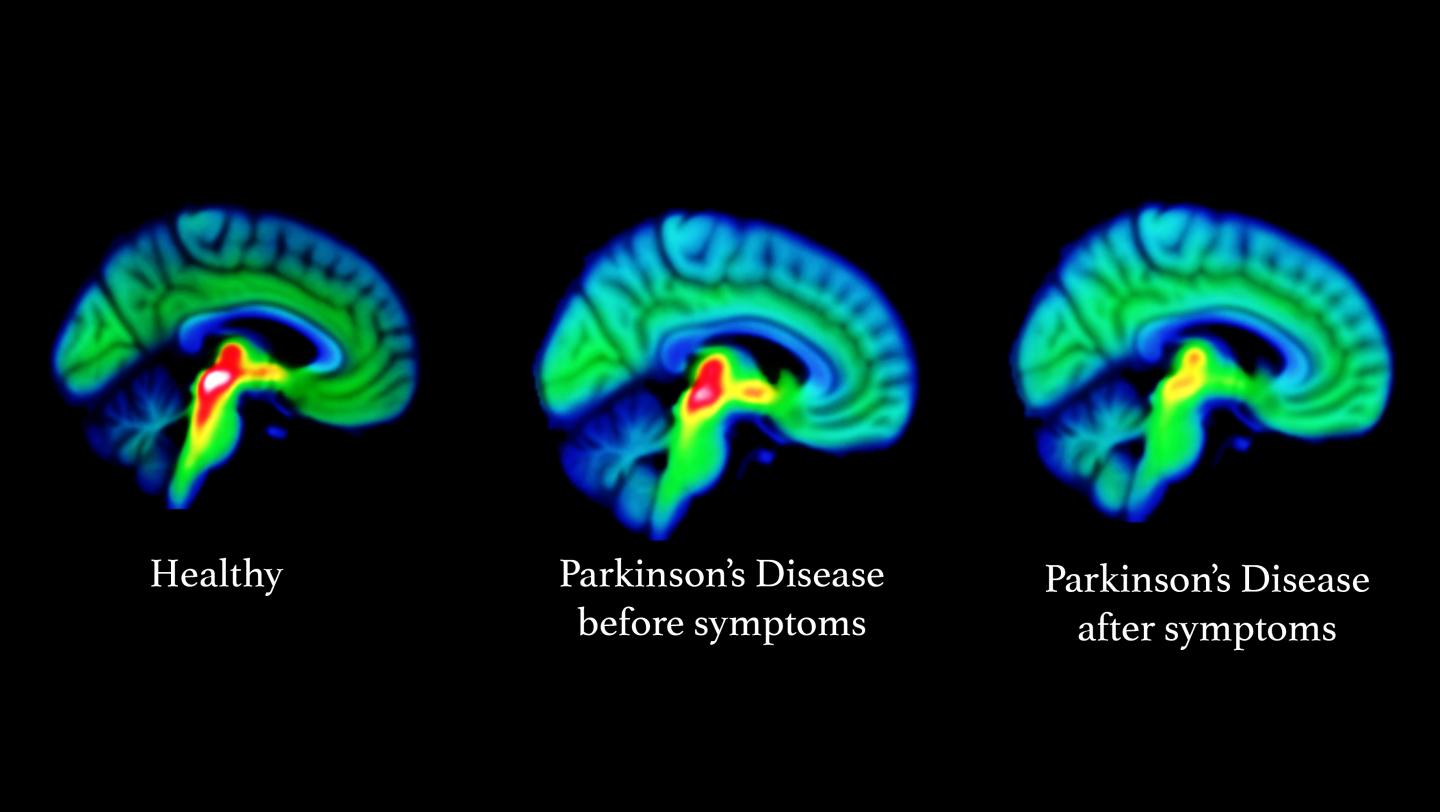 Treating Parkinson's Disease with Ayurveda