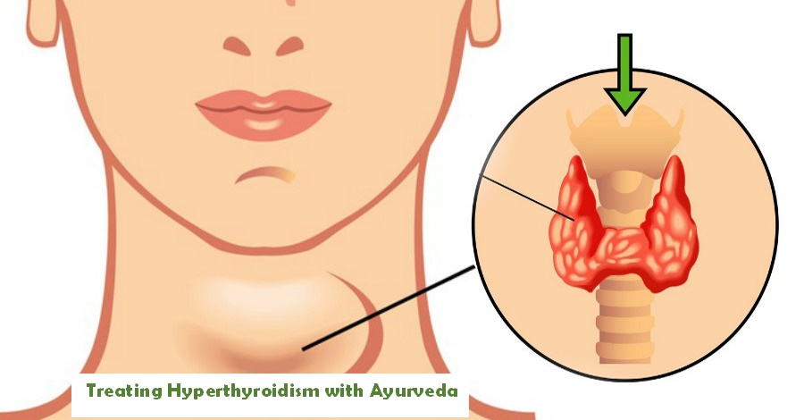 Treating Hyperthyroidism with Ayurveda