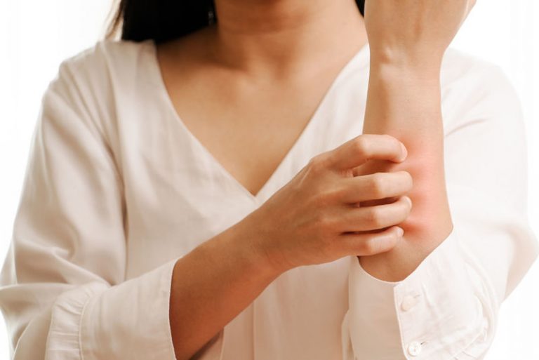 An Ayurvedic Approach for Treatment in Eczema Eczema in Ayurveda